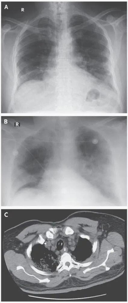 Abnormalities on Chest Imaging of the Saudi patient infected with Coronavirus. Shown are chest radiographs of the patient on the day of admission (Panel A) and 2 days later (Panel B) and computed tomography (CT) 4 days after admission (Panel C).